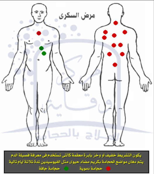 مواضع حجامة داء السكري 1