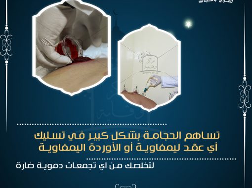 حجامة تسليك الاوعية اللمفاوية