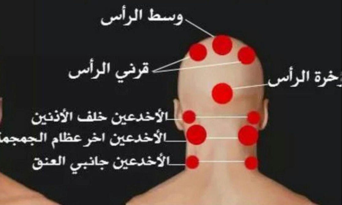 حجامة علي الرأس بدون حلق الشعر د محمد قطب Youtube