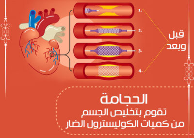 الحجامة تقوم بتخليص الجسم من الكوليسترول الضار